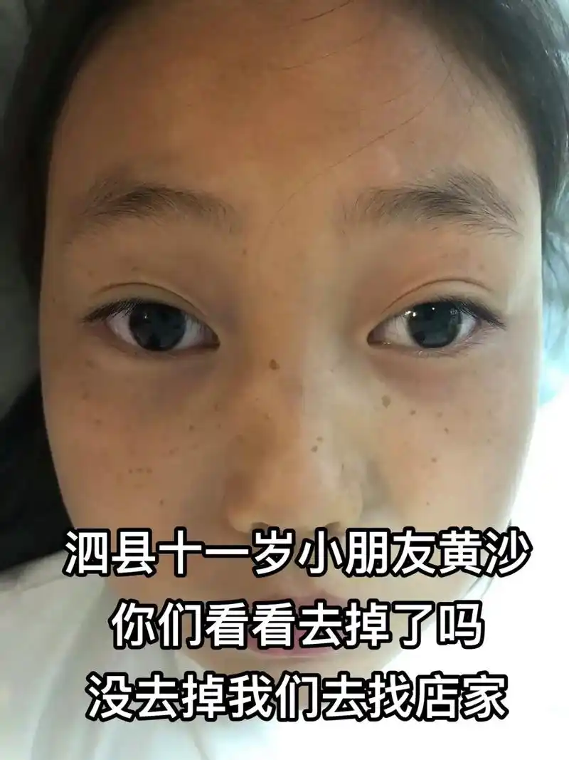 泗县 #黄沙 #雀斑 #灵璧 爱孩子不是给他最好的