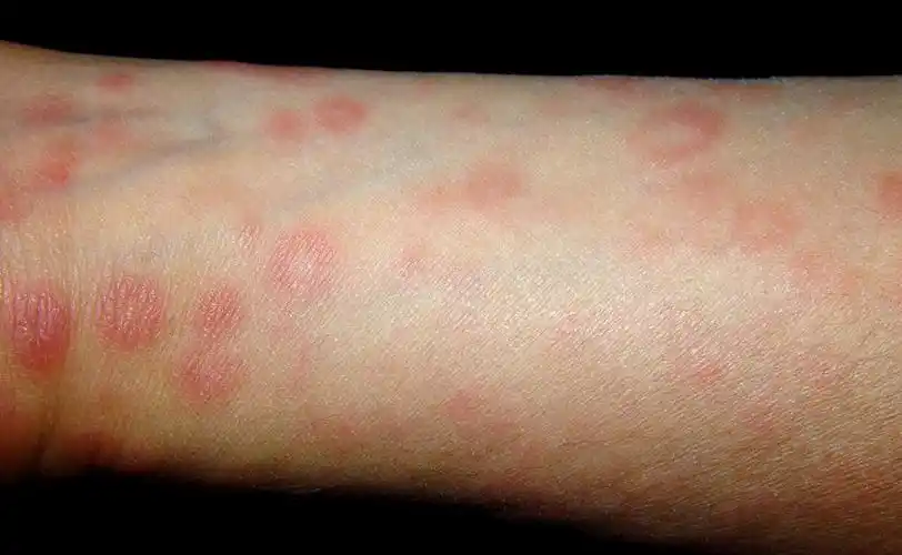 腰背部斑疹性二期梅毒疹图片