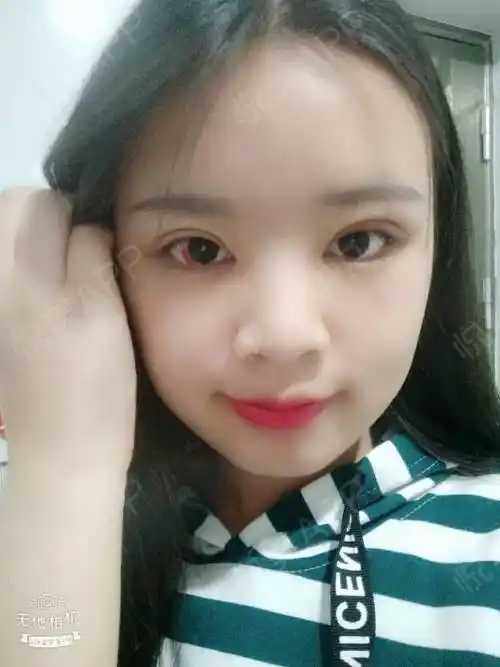 今天休假,在家埋没了一天,做了双眼皮快要10多天了,同事都说我恢复的