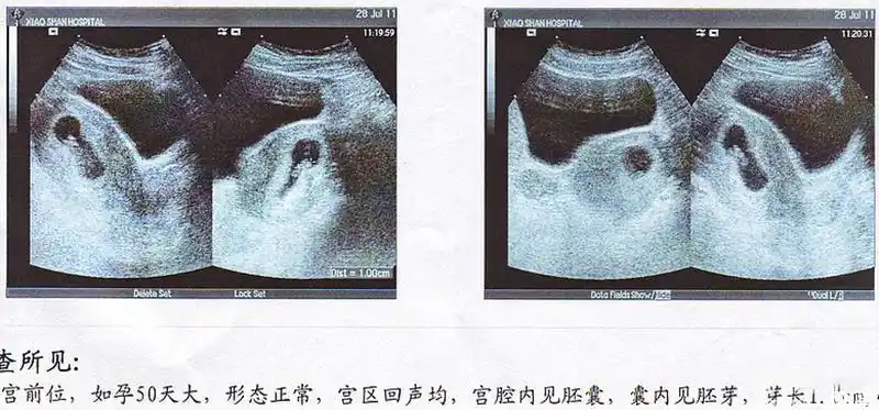 孕囊大小形状看男女公式高准确率or坑人已有定论