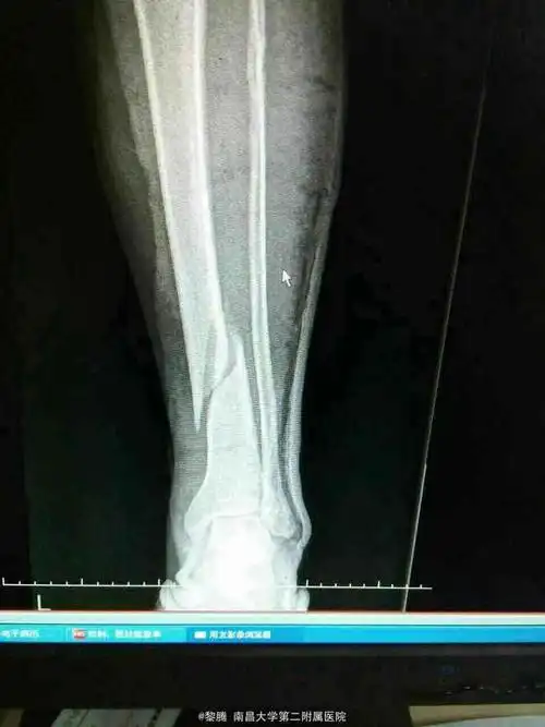 胫腓骨骨折
