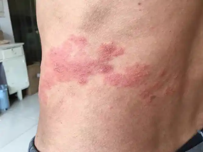 200多例带状疱疹的患者在我这,避免了留下后遗症的痛快,给我机会,我给