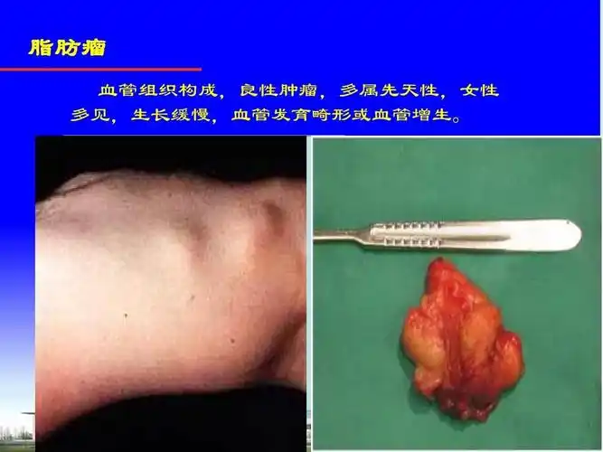 脂肪瘤 血管组织构成,良性肿瘤,多属先天性,女性 多见,生长缓慢,血管