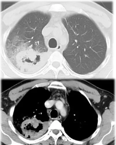 7种肺部常见空洞性疾病