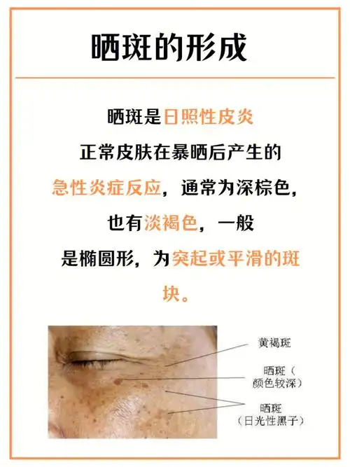 雀斑和晒斑如何区分