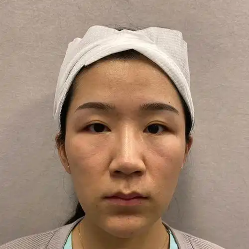 脸上的印第安纹真的很不好看,苹果肌跟被分割了是的,_圈子-新氧美容