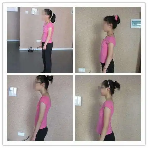 小孩儿驼背不要慌内因找到了让孩子挺直做人