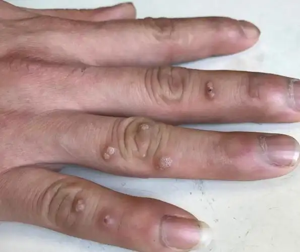 扁平疣,带蒂的叫做丝状疣;1, 瘊子在不同位置定义不同,寻常疣以手上