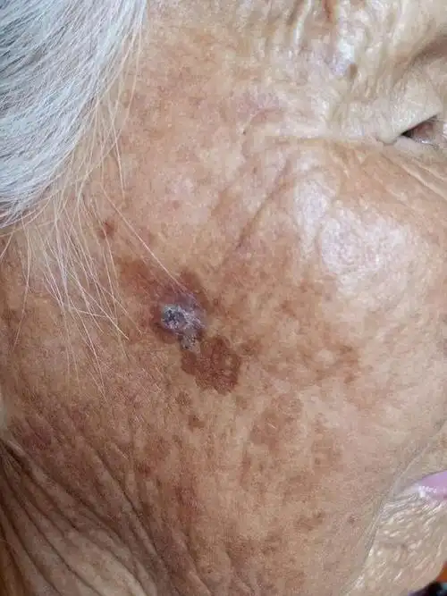 请各位帮忙看看,奶奶脸上的老年斑像长刺一样长了.