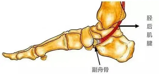 孩子足内侧鼓包凸起,按压会疼,走路也疼?警惕副舟骨问题!