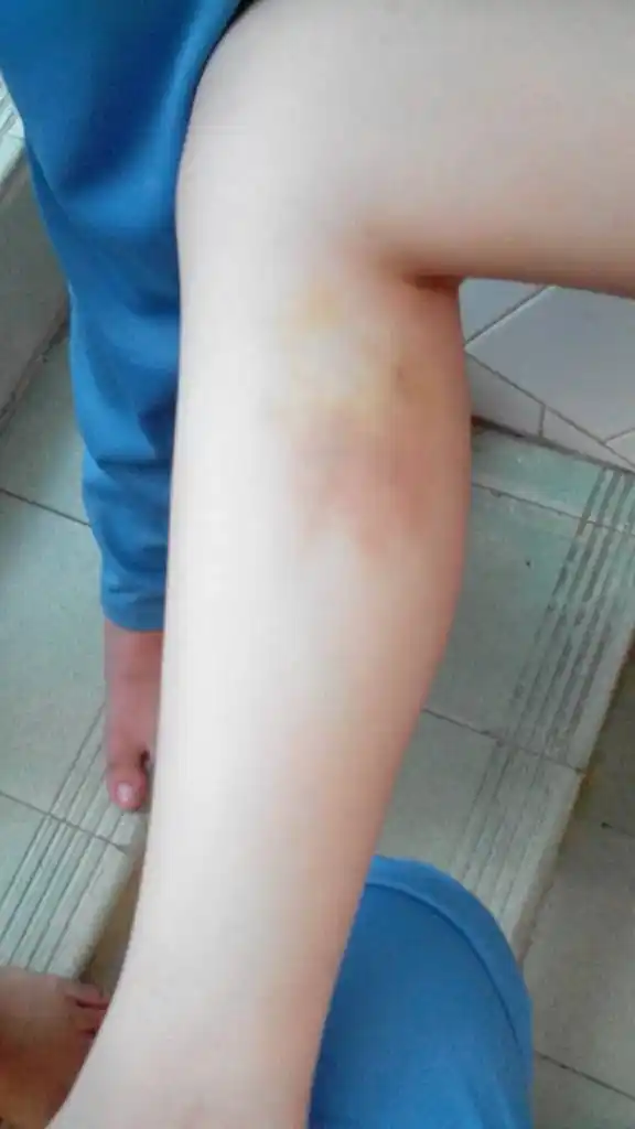 问:为什么我小腿上突然出现淤青,已经两个星期了都没消下去,而且不会