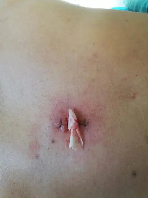 继续查看该图片可能引起不适皮脂腺囊肿(sebaceous cyst)俗称"粉瘤"