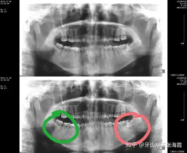怎么看口腔全景片