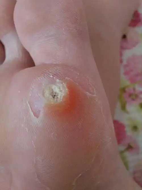 请问医生我脚上的这个鸡眼,硬皮掉下来之后就是图片这样了,有些腐肉