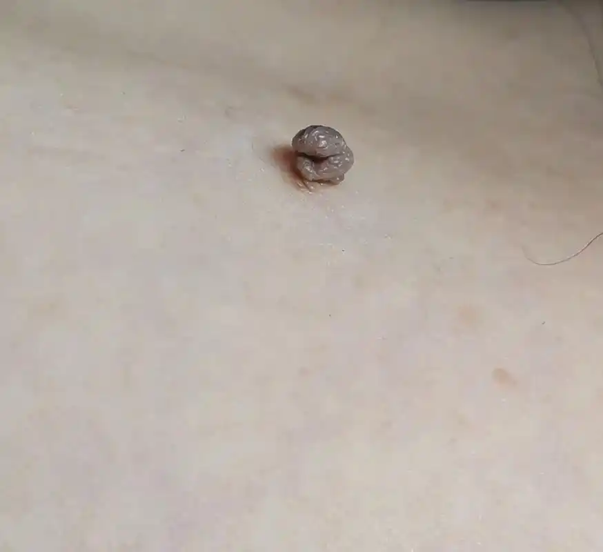 皮赘(软纤维瘤)主要是指由于皮肤纤维结缔组织增生所形成的一种 - 抖