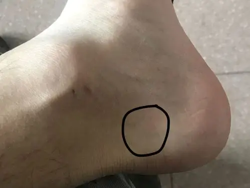 左脚脚踝内侧疼痛