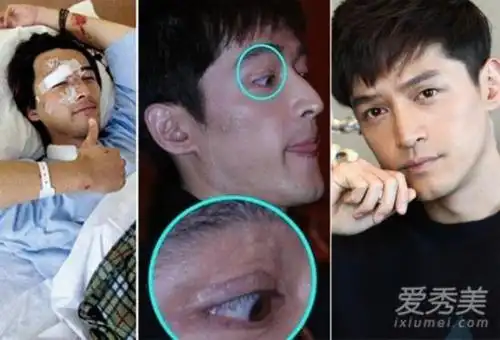 胡歌前女友江疏影发文 揭胡歌车祸真相及车祸前后对比照