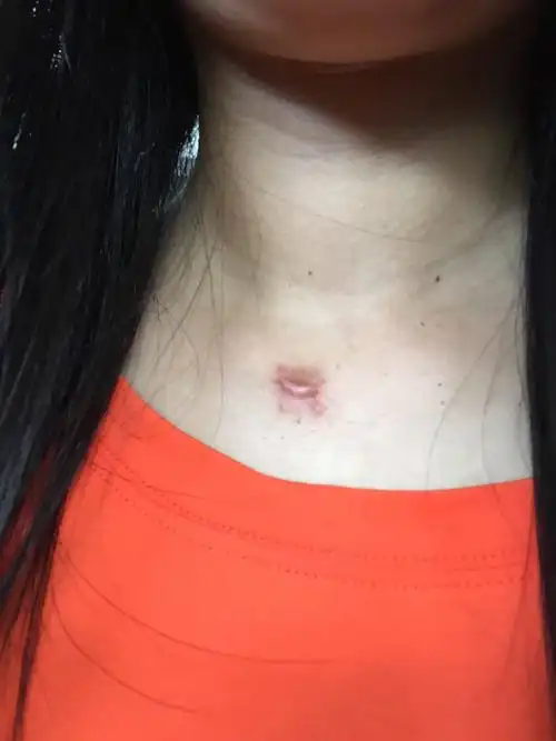 我脖子长了一个粉瘤,医生说对人体没有害,但是我觉得影响美观,我5月份