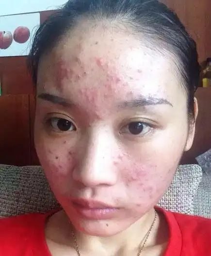 从痘花女到女神,就差一瓶效果好的祛痘产品