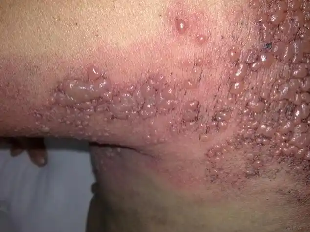 艾滋病片女银屑病的症状图片