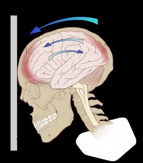 一巴掌拍出脑震荡!这是怎么回事?