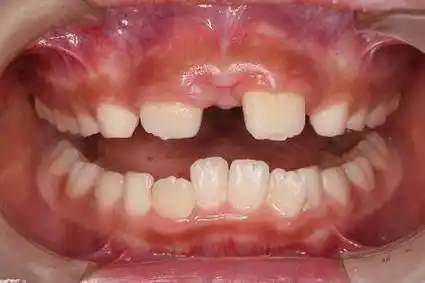 孩子越长越难看?可能就是牙齿的问题