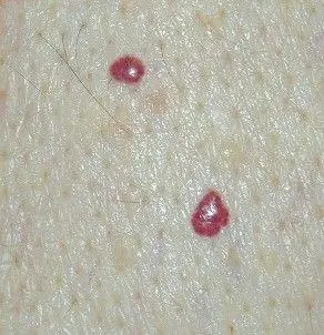 血管痣血管痣大多高出皮面,是由于皮肤表面毛细血管或小动脉增生和