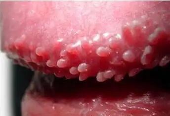 阴茎冠状沟的珍珠疹