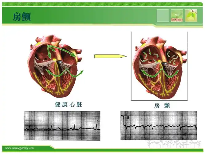 房颤的心电图诊断ppt课件