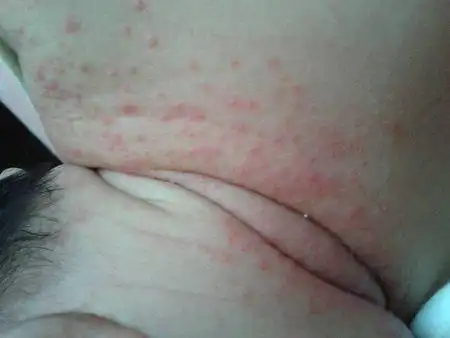 现宝宝刚满月,脖子周围全部是湿疹,好红,肯定会好痒,很难受是吧!