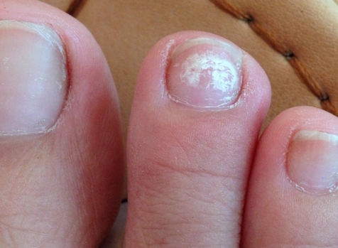 轻微灰指甲图片 (17)_有来医生