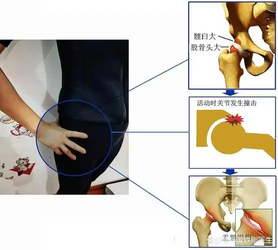 髋关节为什么总是疼痛是股骨头坏死了吗