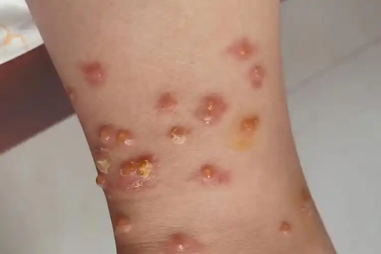 单纯疱疹病毒感染后病程具有自限性,通常为1-2周,但是容易复发.