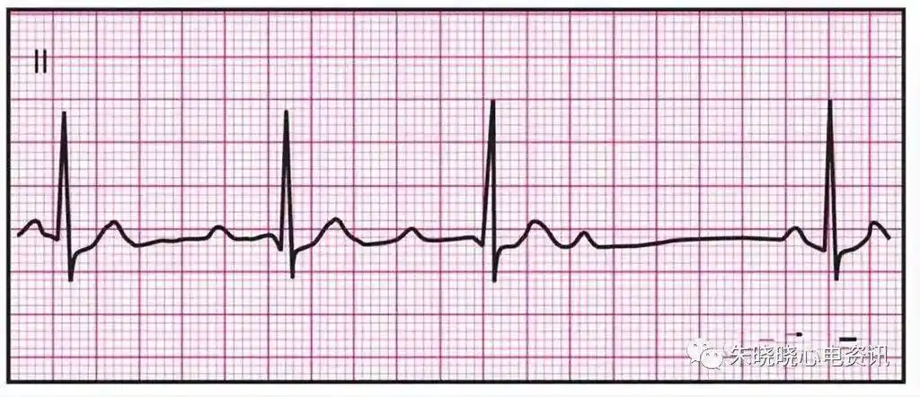 14种异常心电图的临床特点_心室_左束支_房室