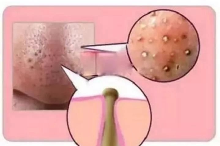 鼻子上挤出来的一条条白色东西,是螨虫还是什么?