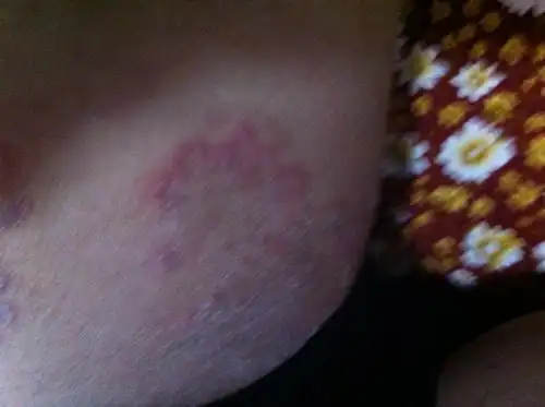 生殖器周围长了很多大片的红块,稍微凸起