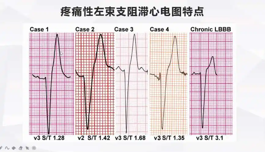 左束支阻滞心电图