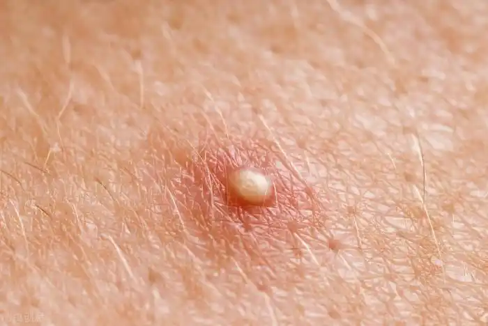 脂肪粒怎么去除小窍门(掌握这两步轻松消除脂肪粒)