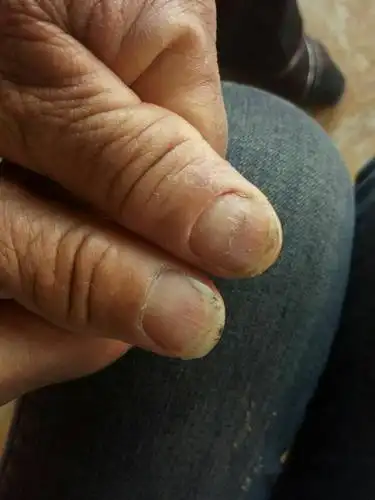 匙状甲甲癣甲分离