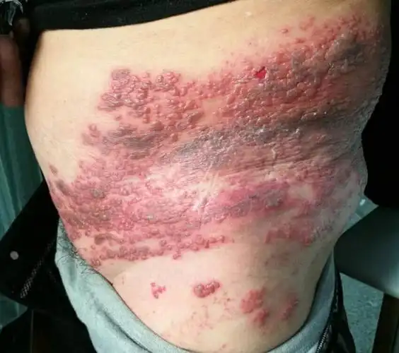 得了带状疱疹,治疗要及早 - 好大夫在线