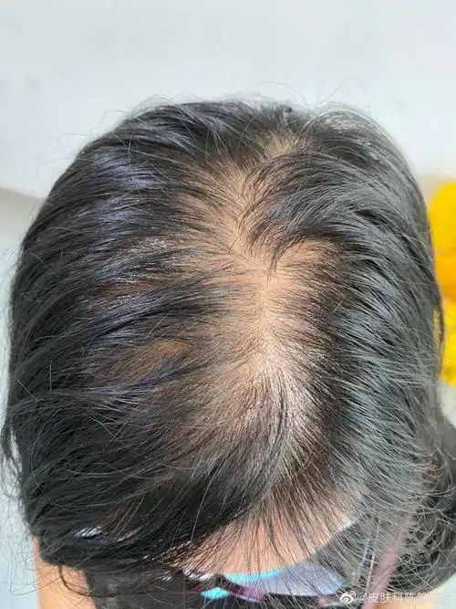 女性如何判断自己是不是雄激素性脱发