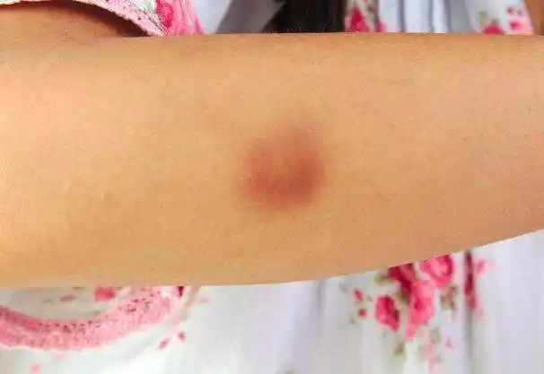 身上长了"脂肪瘤"会怎样?要不要手术切了?一文说清楚