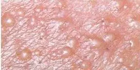 生殖器疱疹的表现一般是在外阴部出现单个或一堆小水泡,局部产生刺痛