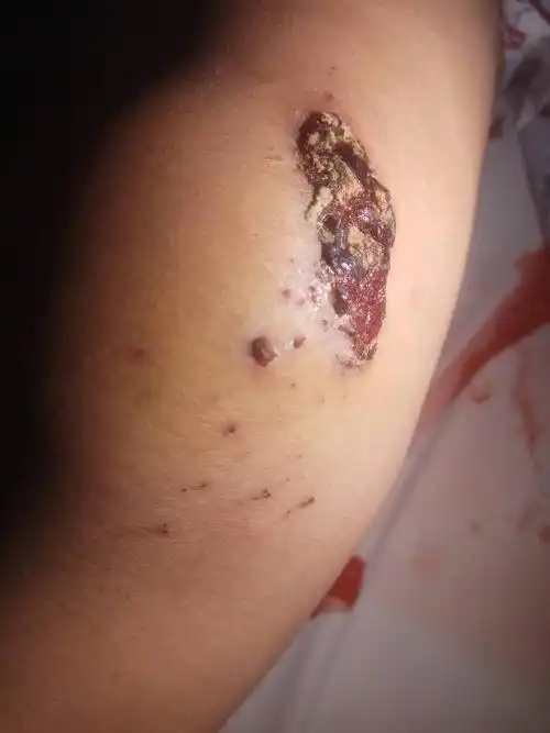 结痂了还挺厚的里面还挺痒痒腿不敢弯太很弯就有那种撕裂的疼弯一点