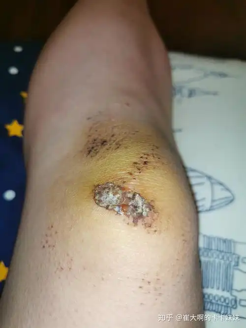 骑车侧翻膝盖摔伤破皮,怎么处理伤口,怎样才能不留疤? - 知乎