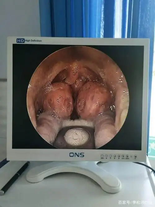 扁桃体肥大度数以及主要症状扁桃体肥大该怎样治疗