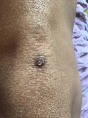 腿上长了个东西,气质很硬求大神解答这是什么 位置大概在膝盖下方