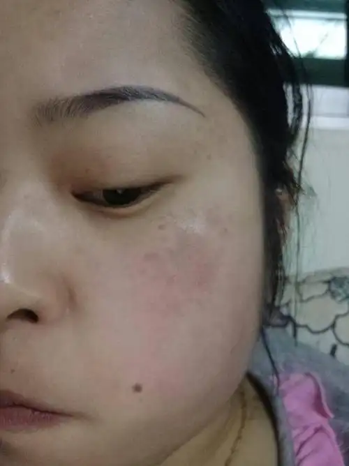 我想请问我脸上的斑是什么斑,没生小孩之前也有,现在生了越多了