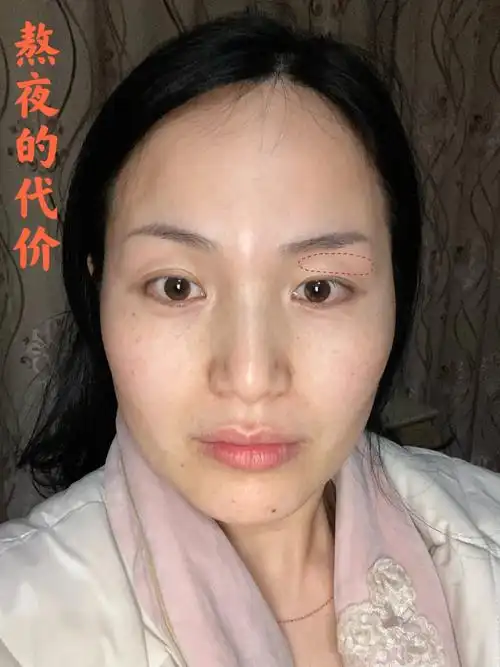 是熬夜对身体不健康,熬夜真的伤气血(节食也是),面部是身体的一面镜子