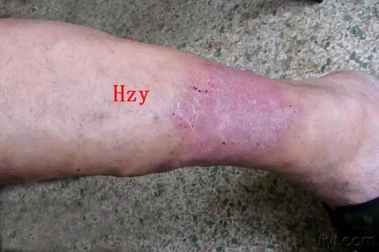 左小腿皮损时轻时重十年(二)